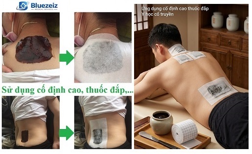 Hướng dẫn sử dụng băng dính thoáng khí cố định thuốc đắp đông y đúng cách tại nhà